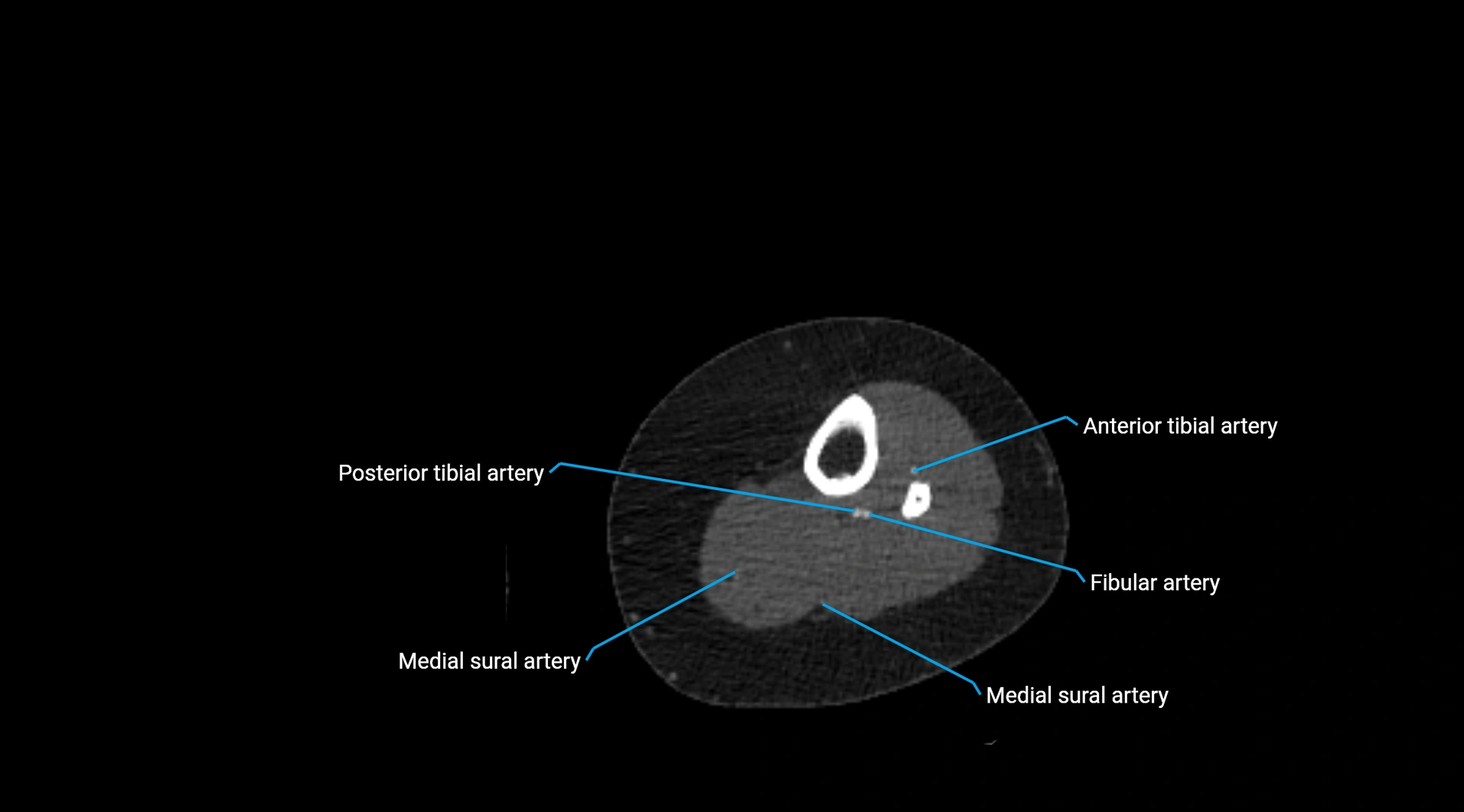 CTA lower limb cross sectional anatomy labelled image _202.webp